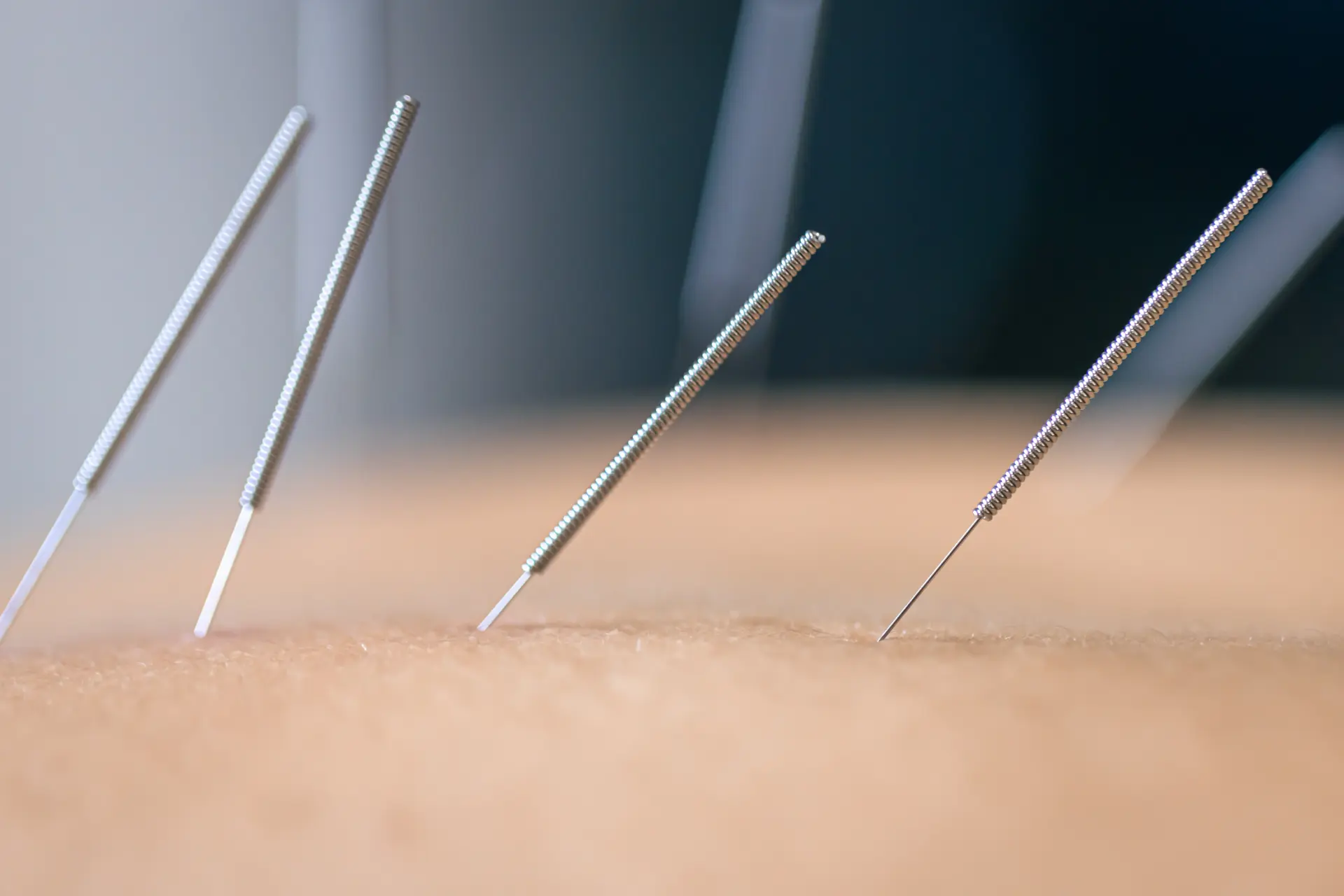Acupuncture and PCOS/PMOS: What does the Research Show?